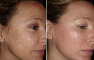 լազերային դեմքի մաշկի երիտասարդացում `լուսանկարներից առաջ և հետո